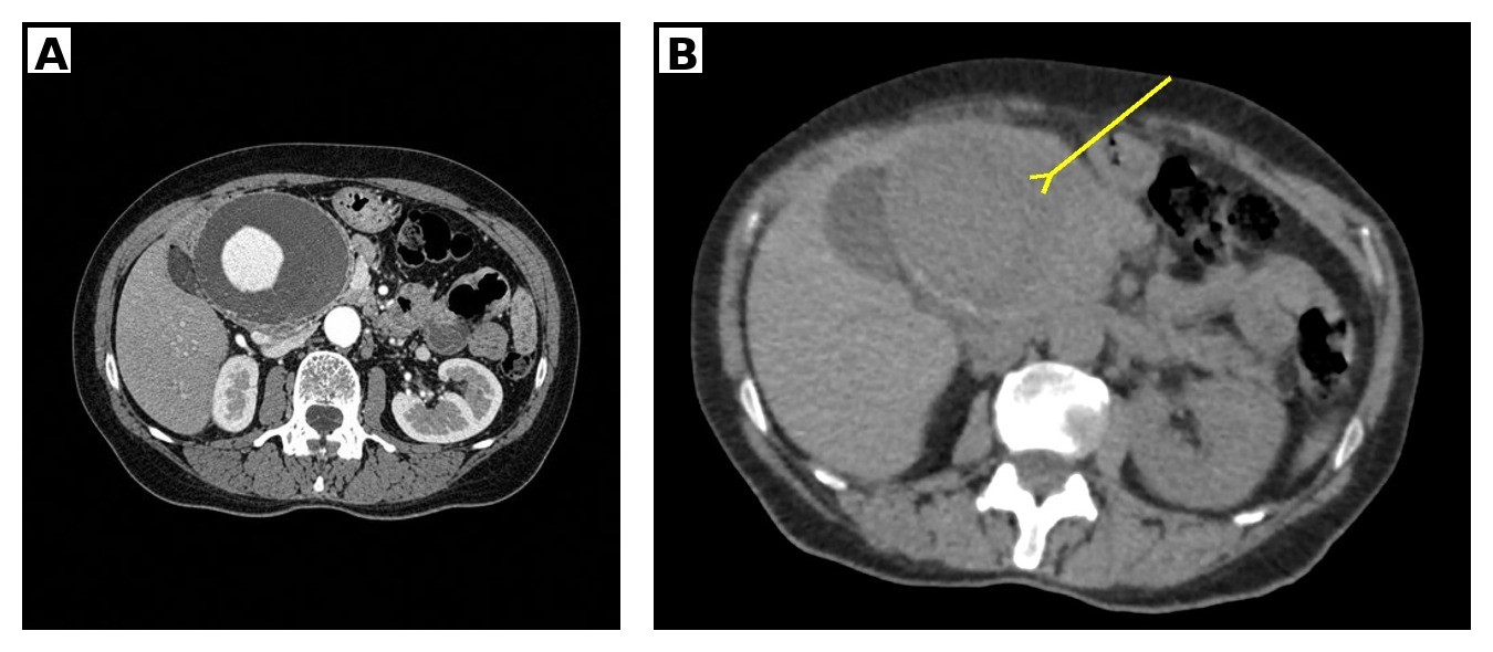 Ferreira_Figure 1_hepatic_artery_aneurysm