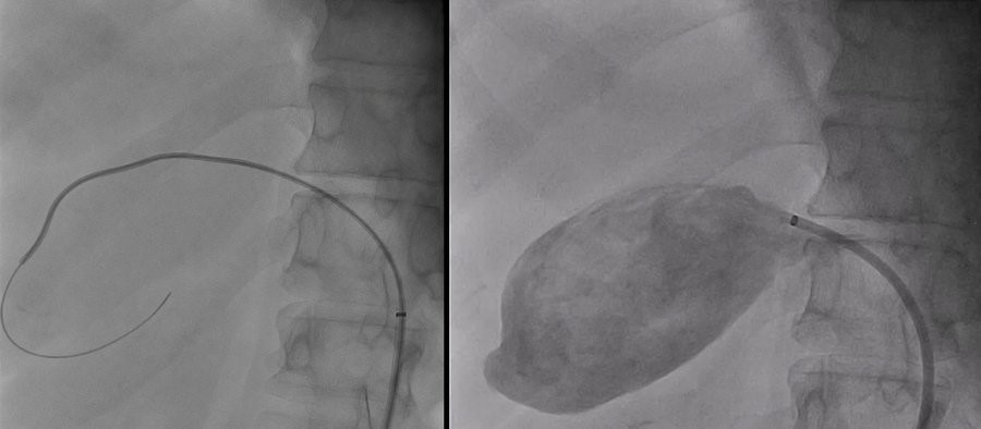 Figure 2. Angiographic findings and endovascular treatment