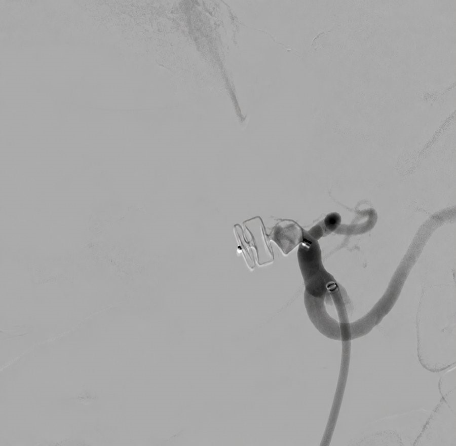 Figure 3. Final angiographic result