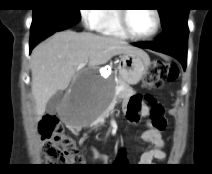 Figure 4. Four-month follow-up computed tomography